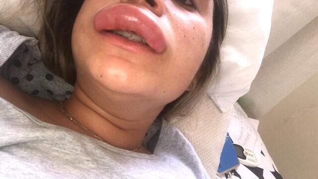 Губа Шахар после инъекции. Фото: личный альбом (באדיבות המצולמת) Губа Шахар после инъекции. Фото: личный альбом