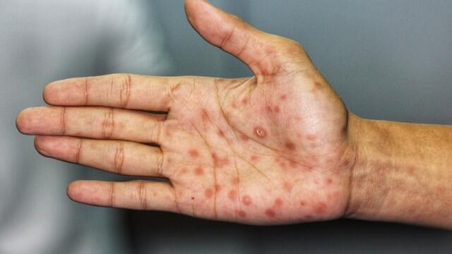 Сыпь при сифилисе. Фото: shutterstock (צילום: shutterstock) Сыпь при сифилисе. Фото: shutterstock