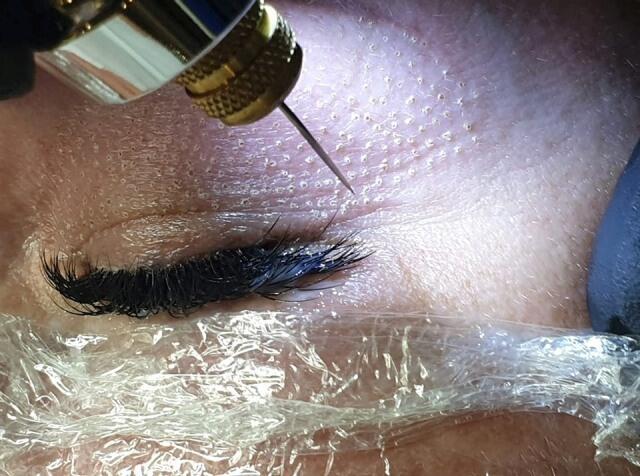 Процедура мягкой блефаропластики с помощью Luxus Plasma Liner (Фото: Катя Наве) Процедура мягкой блефаропластики с помощью Luxus Plasma Liner