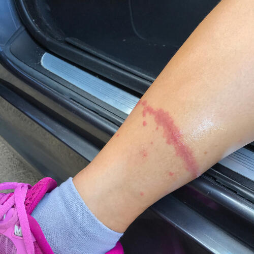 Ожог, оставленный стрекательными клетками медузы. Фото: shutterstock (Фото: shutterstock) Ожог, оставленный стрекательными клетками медузы. Фото: shutterstock