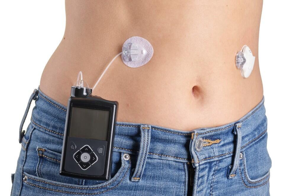 Умная инсулиновая помпа. Фото: Medtronic (צילום: מדטרוניק) Умная инсулиновая помпа. Фото: Medtronic