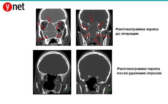 Рентгенограмма черепа (Рентгенограмма черепа) Рентгенограмма черепа