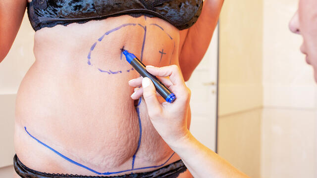 "The tummy tuck was perfect, the thighs—less so." 