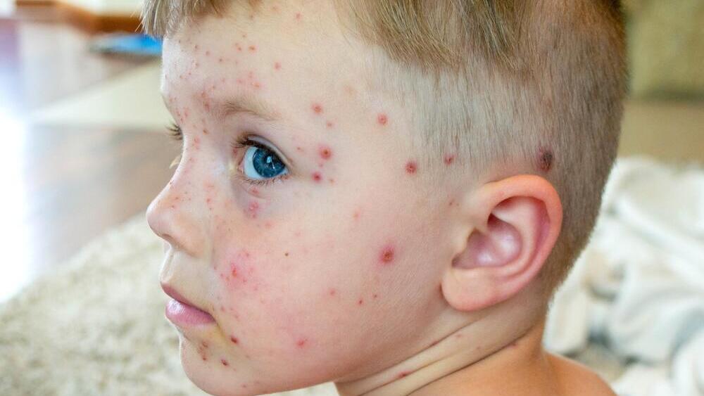 אבעבועות רוח