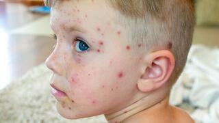 אבעבועות רוח