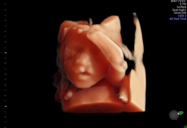 חך שסוע שפה שסועה