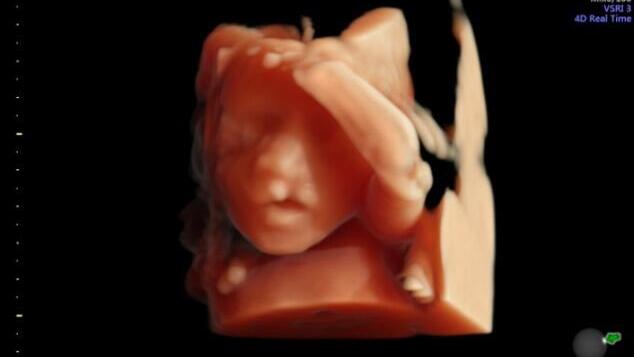 חך שסוע שפה שסועה