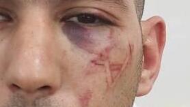  תושב מזרח ירושלים החשוד בעבירות סחר בסמים פצוע במעצרו