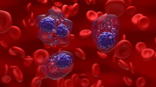 תאים סרטניים במיאלומה נפוצה