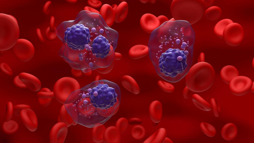 Cancer cells in multiple myeloma (Photo: Shutterstock) תאים סרטניים במיאלומה נפוצה