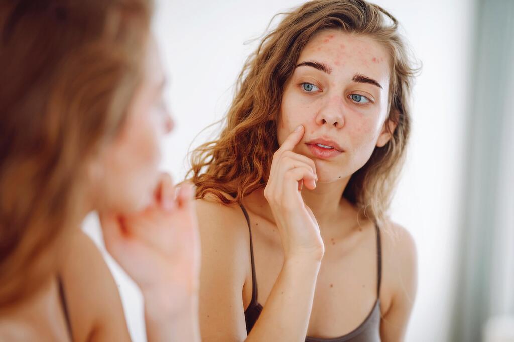Our skin responds directly to hormonal fluctuations (Photo: Shutterstock) אקנה