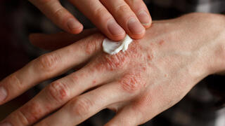 פסוריאזיס מחלת עור