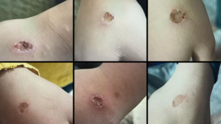 הסימנים שנמצאו על הילדים לאחר שהמדריך כיבה עליהם סיגריות