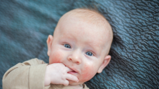 אטופיק דרמטיטיס