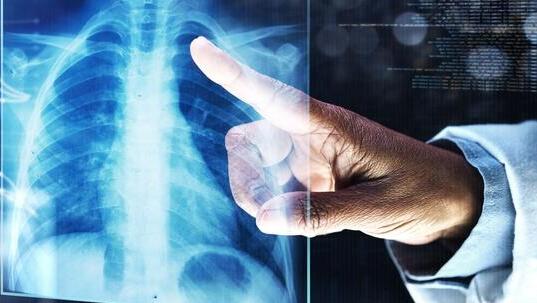 סרטן ריאה. אילוסטרציה 