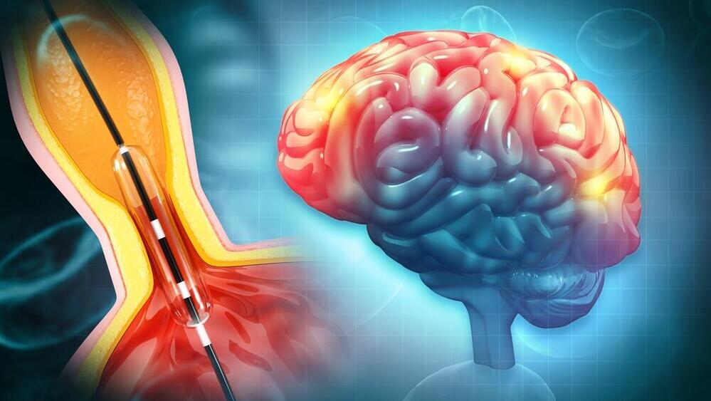 צנתור מוח בעקבות שבץ מוחי