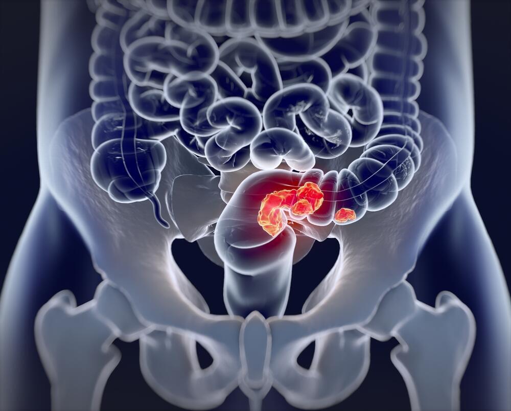 Colorectal cancer (Photo: shutterstock) סרטן המעי הגס