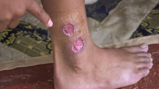 שושנת יריחו, לישמניה, מחלת עור. אילוסטרציה