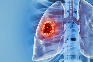 סרטן ריאות