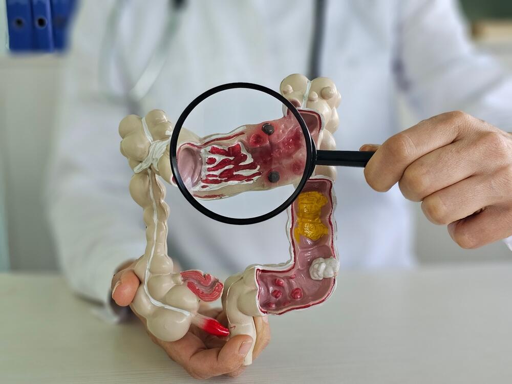 Colorectal cancer: early detection saves lives (Photo: Shutterstock) סרטן המעי הגס