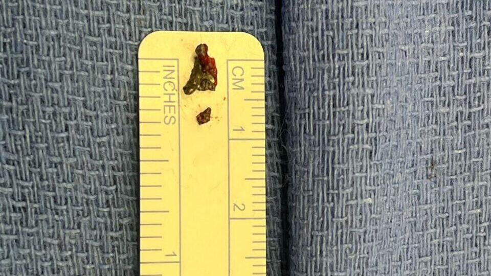 Shrapnel removed from M.'s Body
