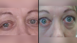 מחלת עיניים טד