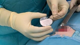 קוצב סקראלי