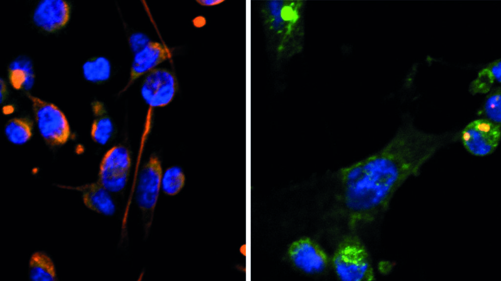 OVOL proteins transfer breast cancer cells from an active state (right) to a dormant state (left) (Photo: Weizmann Institute of Science) חלבוני OVOL מעבירים את תאי סרטן השד ממצב פעיל למצב רדום. משמאל: תאי סרטן שד פעילים המאופיינים בחלוקה מהירה ובתנועתיות מוגברת, מימין: תאי סרטן שד שנכנסו לתרדמה בעקבות ביטוי יתר של OVOL1 (בכחול – גרעיני התאים, בכתום – סמן המאפיין תאי סרטן שד פעילים, בירוק – סמן המאפיין תאי סרטן שד רדומים)