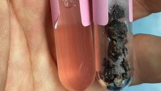 שיטה לאבחון סוג האבן בכליה לאחר ריסוקה בלייזר