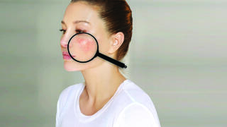 "הטיפול בלופוס עבר בשנים האחרונות התקדמות משמעותית."