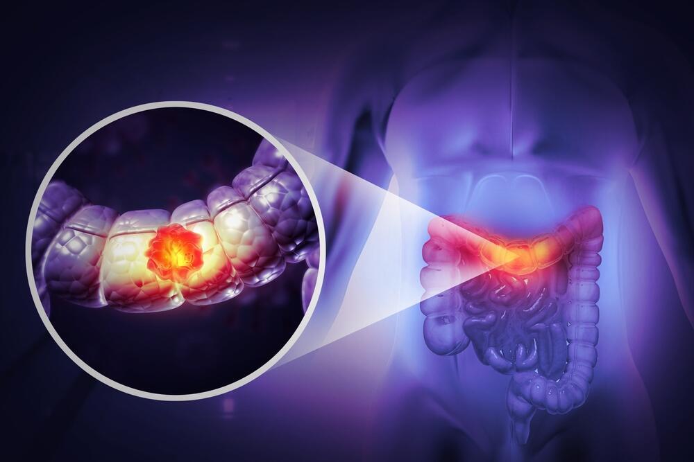 Colorectal cancer can be detected early and prevented (Photo: Shutterstock) סרטן המעי הגס