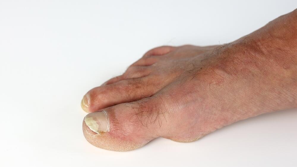 a nail that turns yellow, changes shape, thickens or becomes more brittle is not something to ignore (Photo: Shutterstock) פטרת ציפורניים