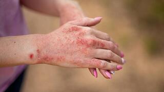 אטופיק דרמטיטיס