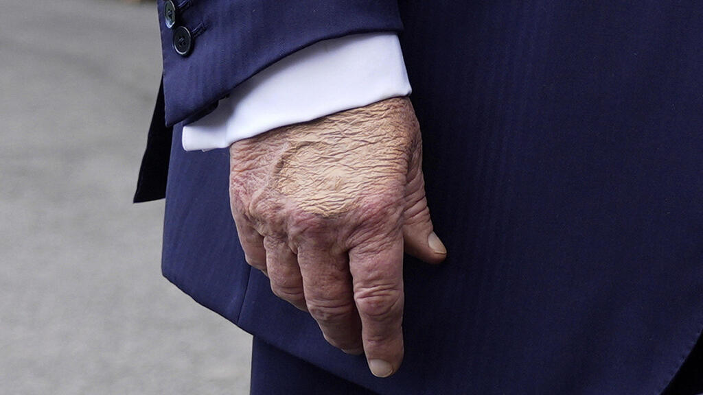 דונלד טראמפ יד חבולה