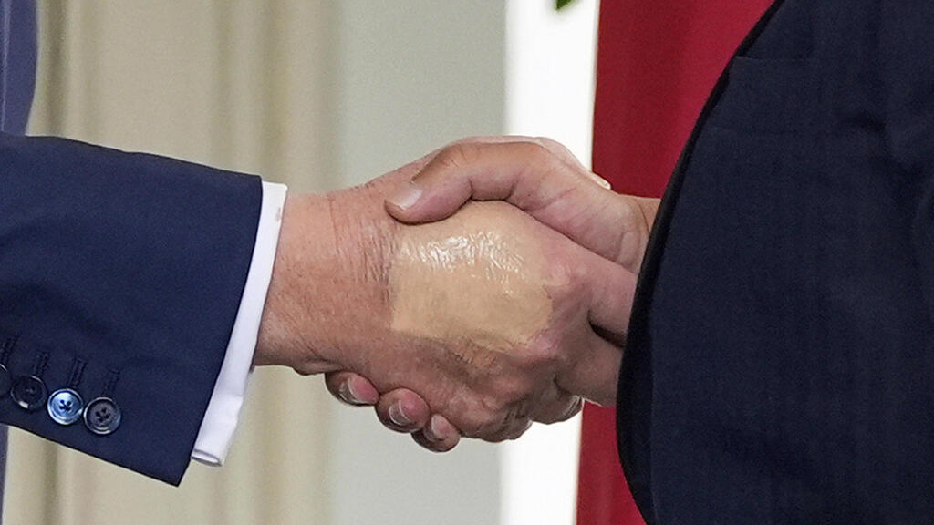 דונלד טראמפ יד חבולה