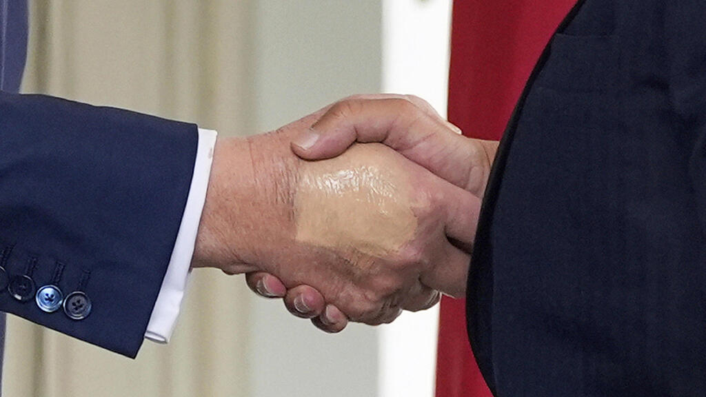 דונלד טראמפ יד חבולה