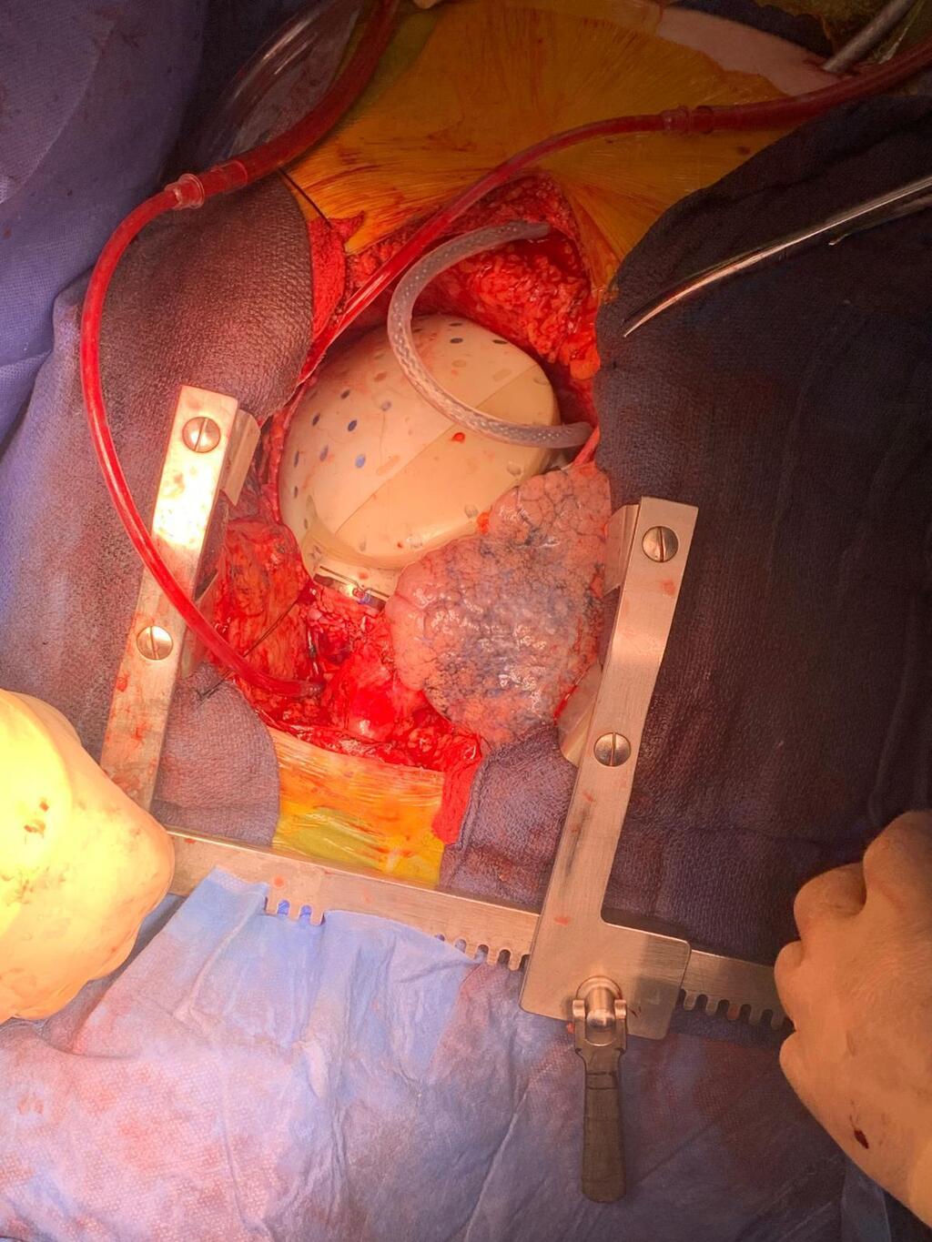 Hadassah University Medical Center successfully implanted a full artificial heart