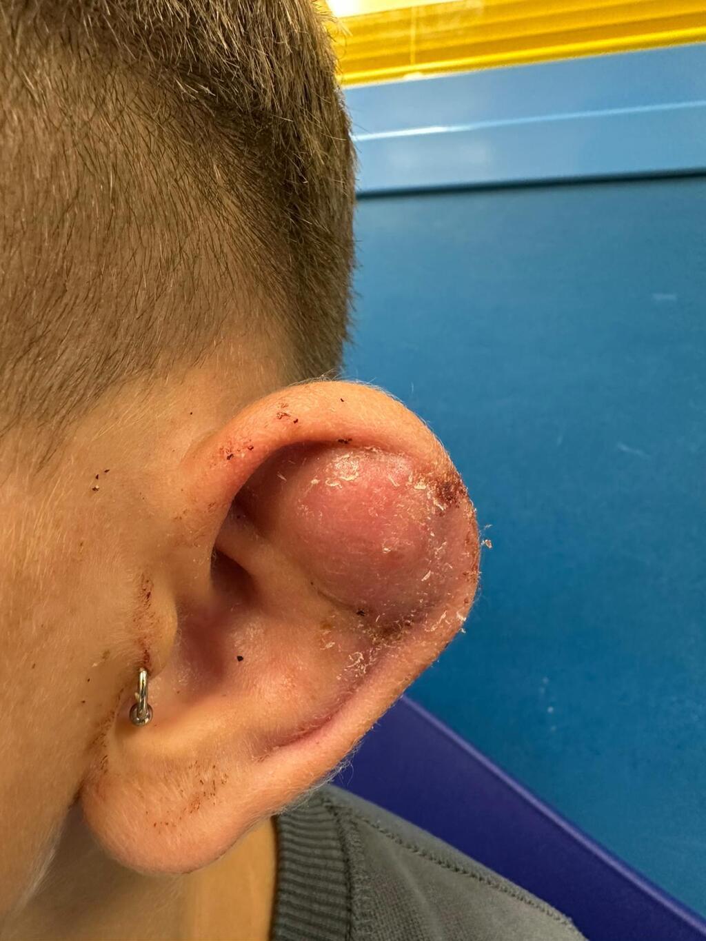 אביתר, זיהום באוזן