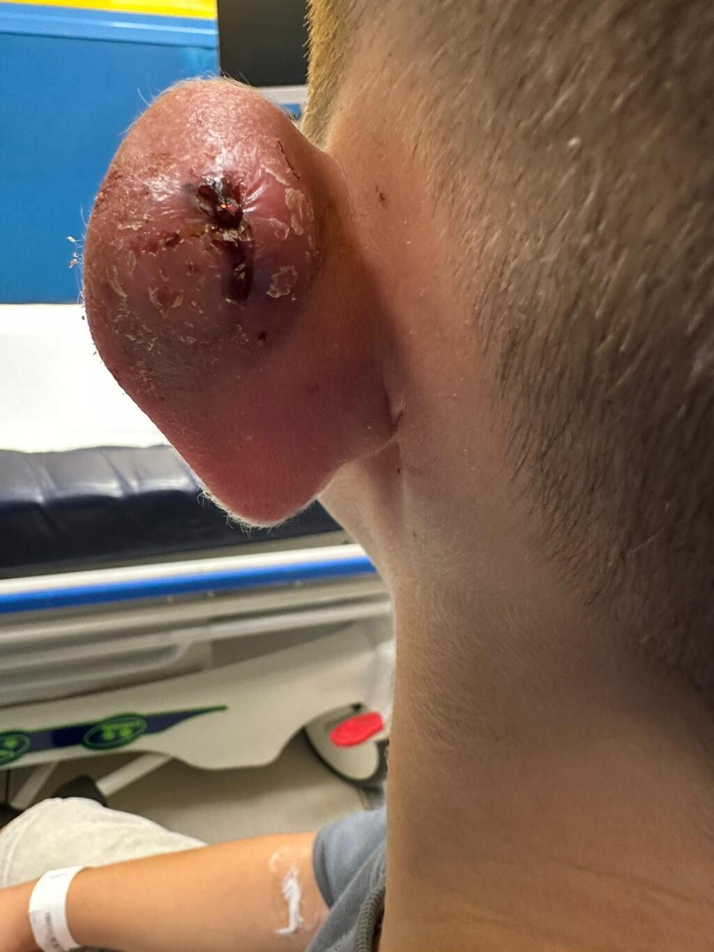 אביתר, זיהום באוזן