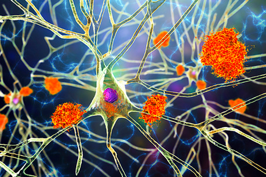 An illustration of neurons from an Alzheimer’s patient, showing amyloid beta protein deposits