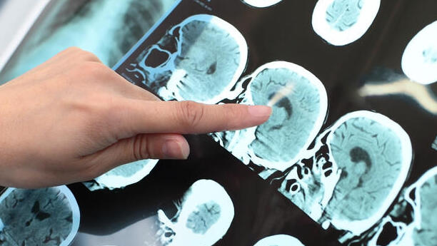 נזק מוחי בעקבות אלצהיימר