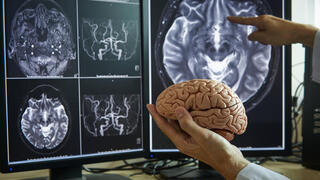 כך מתפשט אלצהיימר: התא נפטר מחלבון - ומדביק עוד