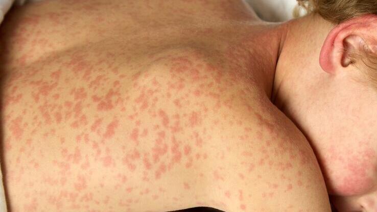 ילד חולה חצבת