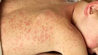 ילד חולה חצבת