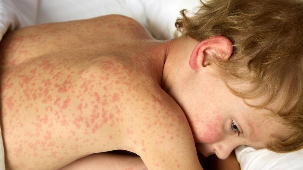 ילד חולה חצבת