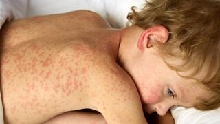 ילד חולה חצבת