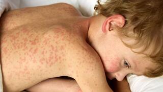 ילד חולה חצבת