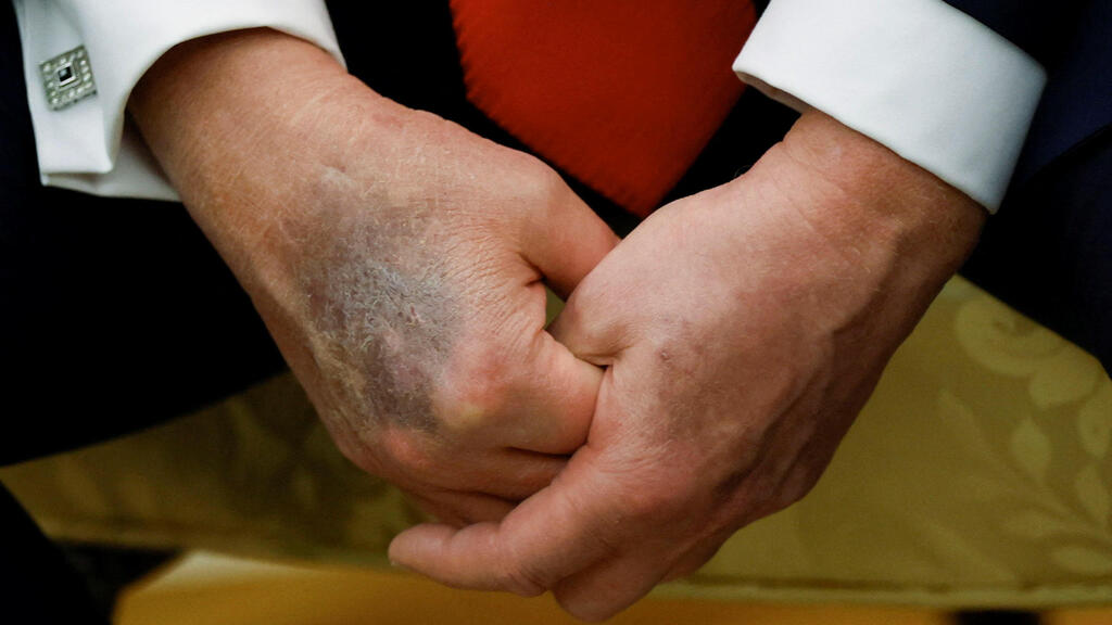 חבורה פצע על כף יד ימין של נשיא ארה"ב טראמפ באירוע בבית הלבן