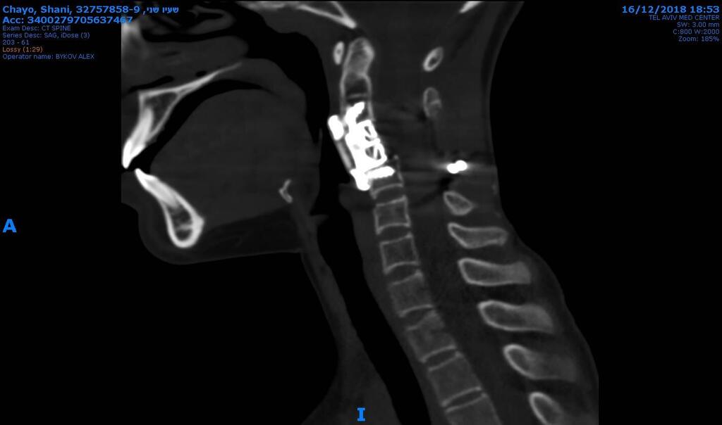 שני שעיו עברה ניתוח להסרת חוליה נגועה בסרטן. בצילום CT זה מודגם מצב לאחר ניתוח שבו הוסרה החוליה הנגועה בשלמותה הצילום מראה את השתלת החוליה המלאכותית 