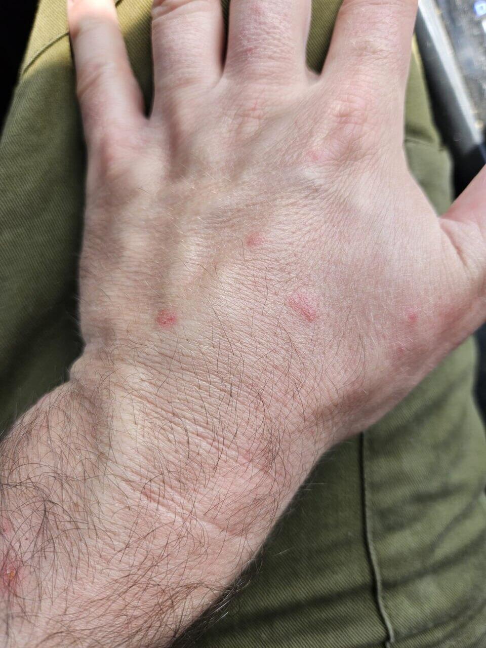 מכת פשפשים מאיימת על בריאות המילואימניקים  במגננים